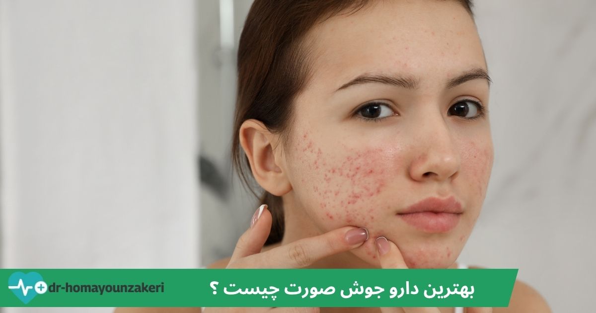 بهترین دارو جوش صورت چیست؟